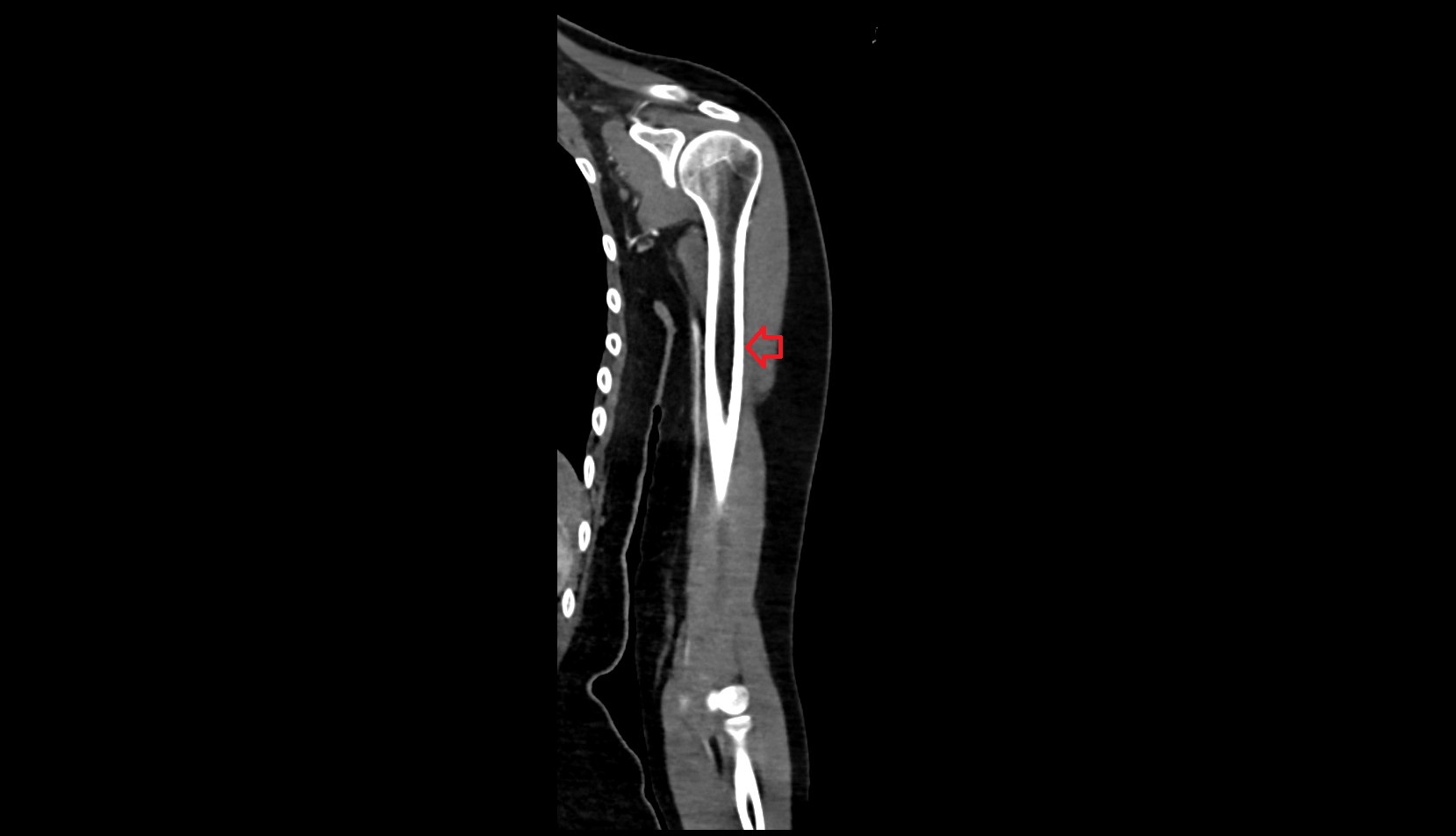 Lateral border of humerus ct