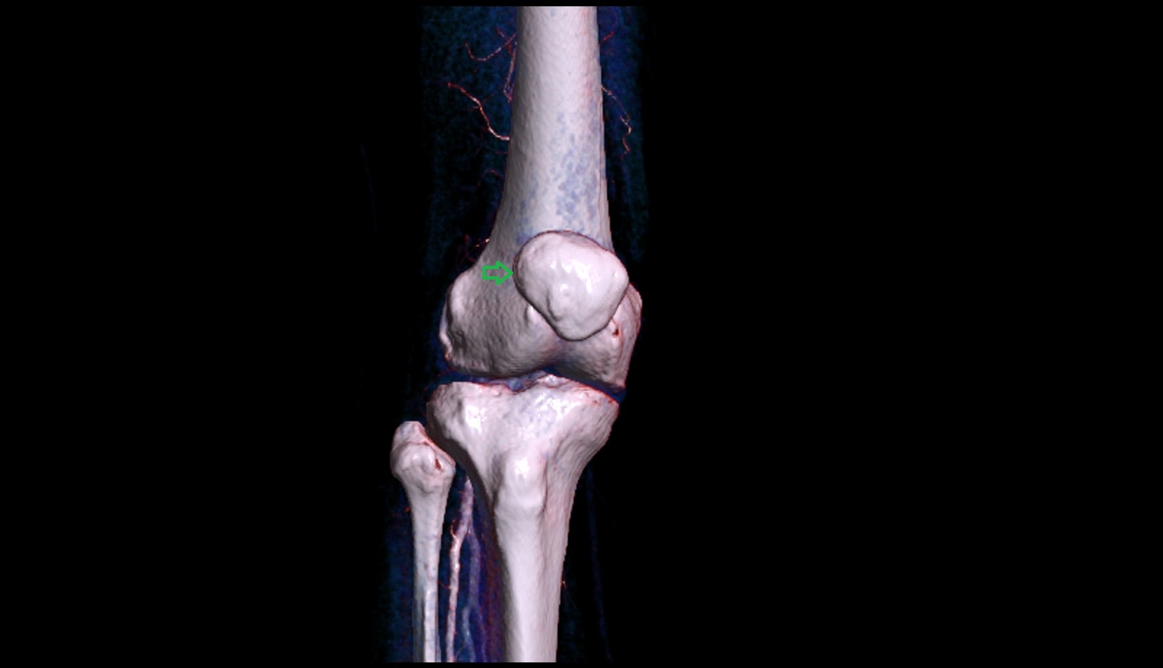 Lateral border of patella