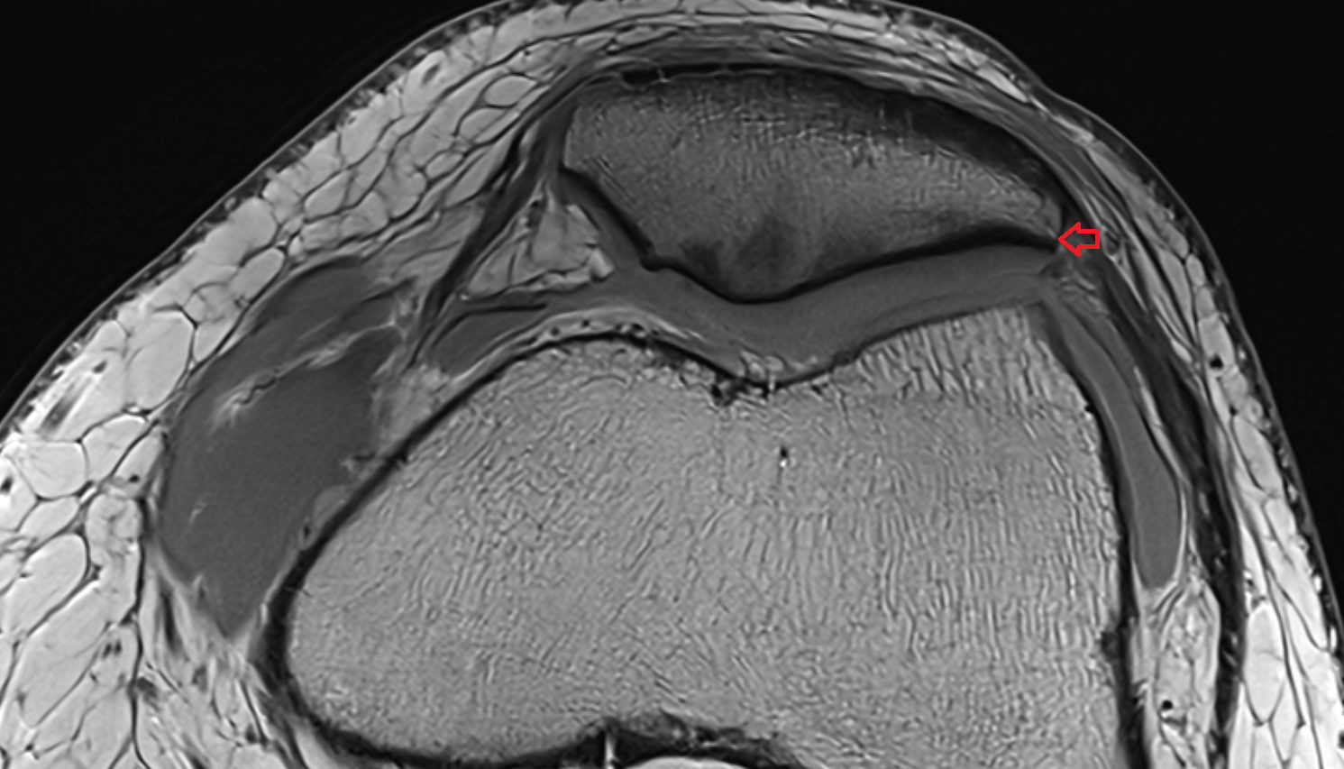 Lateral border of patella axial cross sectional anatomy 3T MRI AI enhanced  radiology  anatomy image-img-00000-00000