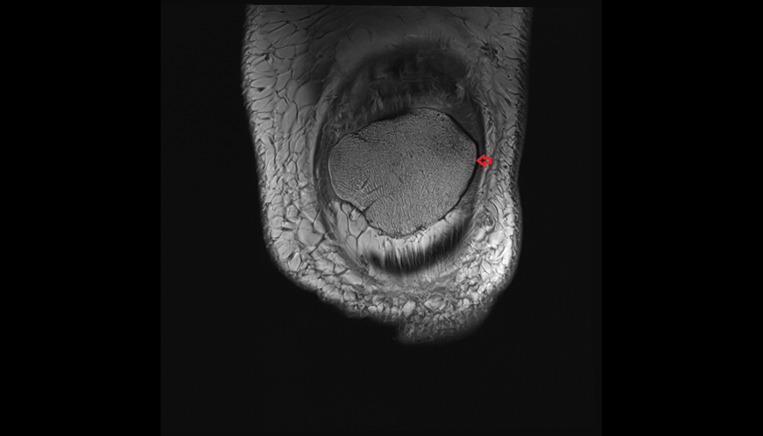 Lateral border of patella coronal cross sectional anatomy 3T MRI AI enhanced  radiology  anatomy image-img-00000-00000