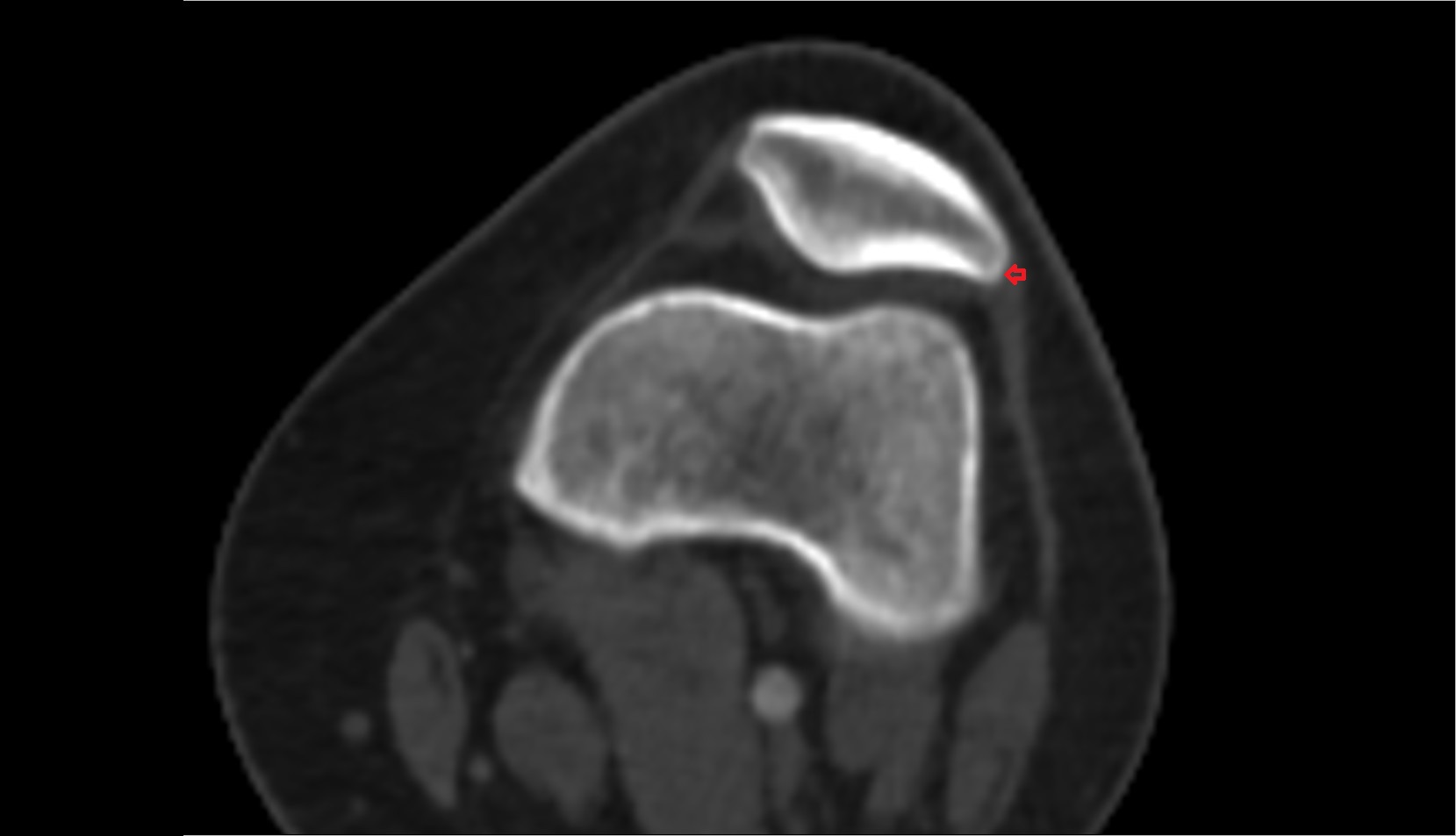 Lateral border of patella ct axial