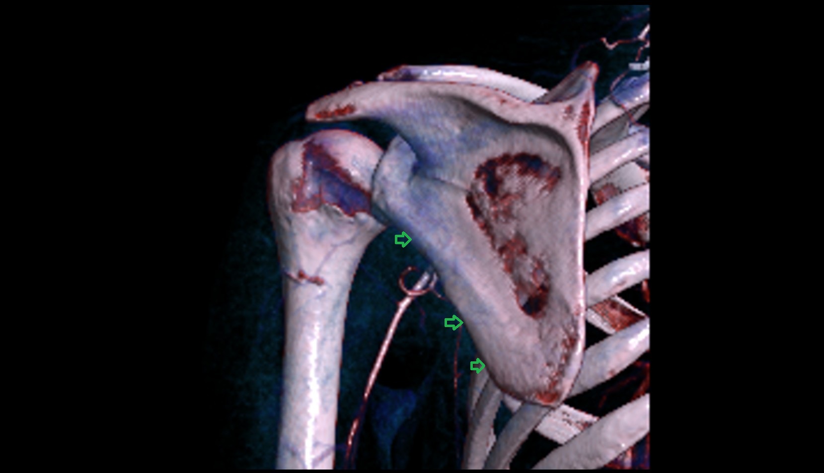 Lateral border of scapula