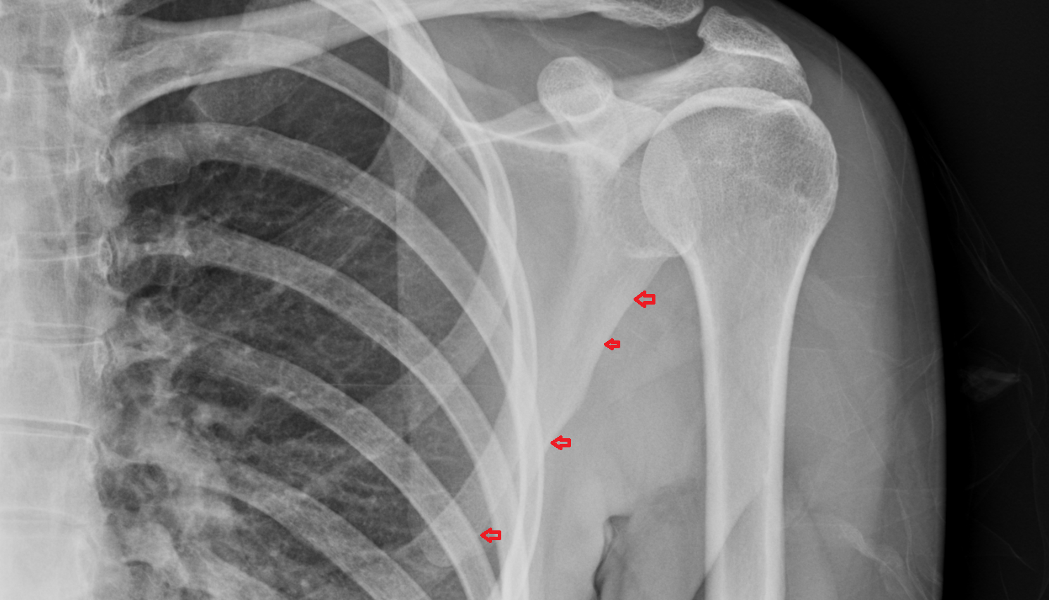 Lateral border of scapula x ray anatomy labelled image-img-00000-00000