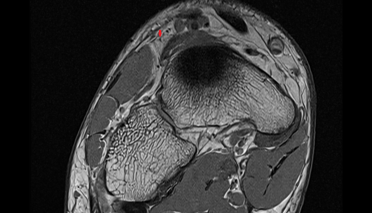Lateral branch of deep fibular nerve coronal cross sectional anatomy 3T MRI AI enhanced radiology image-img-00000-00000
