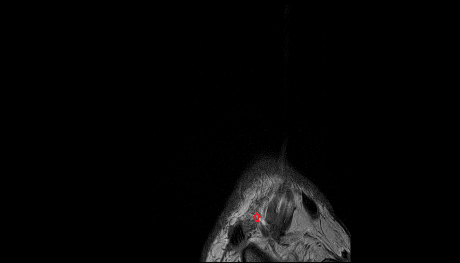 Lateral branch of deep fibular nerve coronal cross sectional anatomy 3T MRI AI enhanced radiology image-img-00000-00000_00001