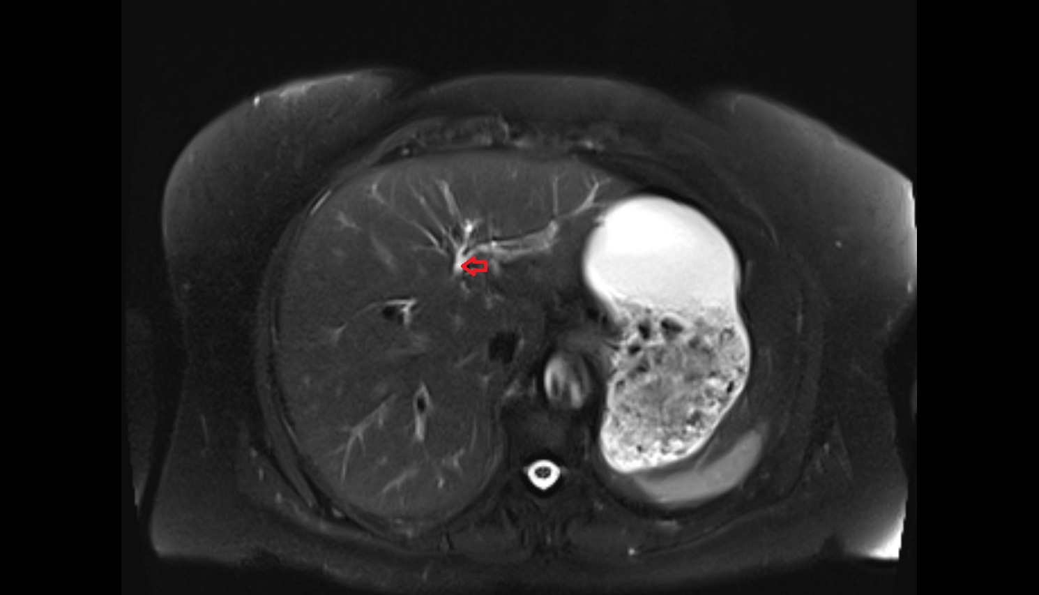 Lateral branch of left hepatic duct  mri  coronal  anatomy  image-img-00000-00000