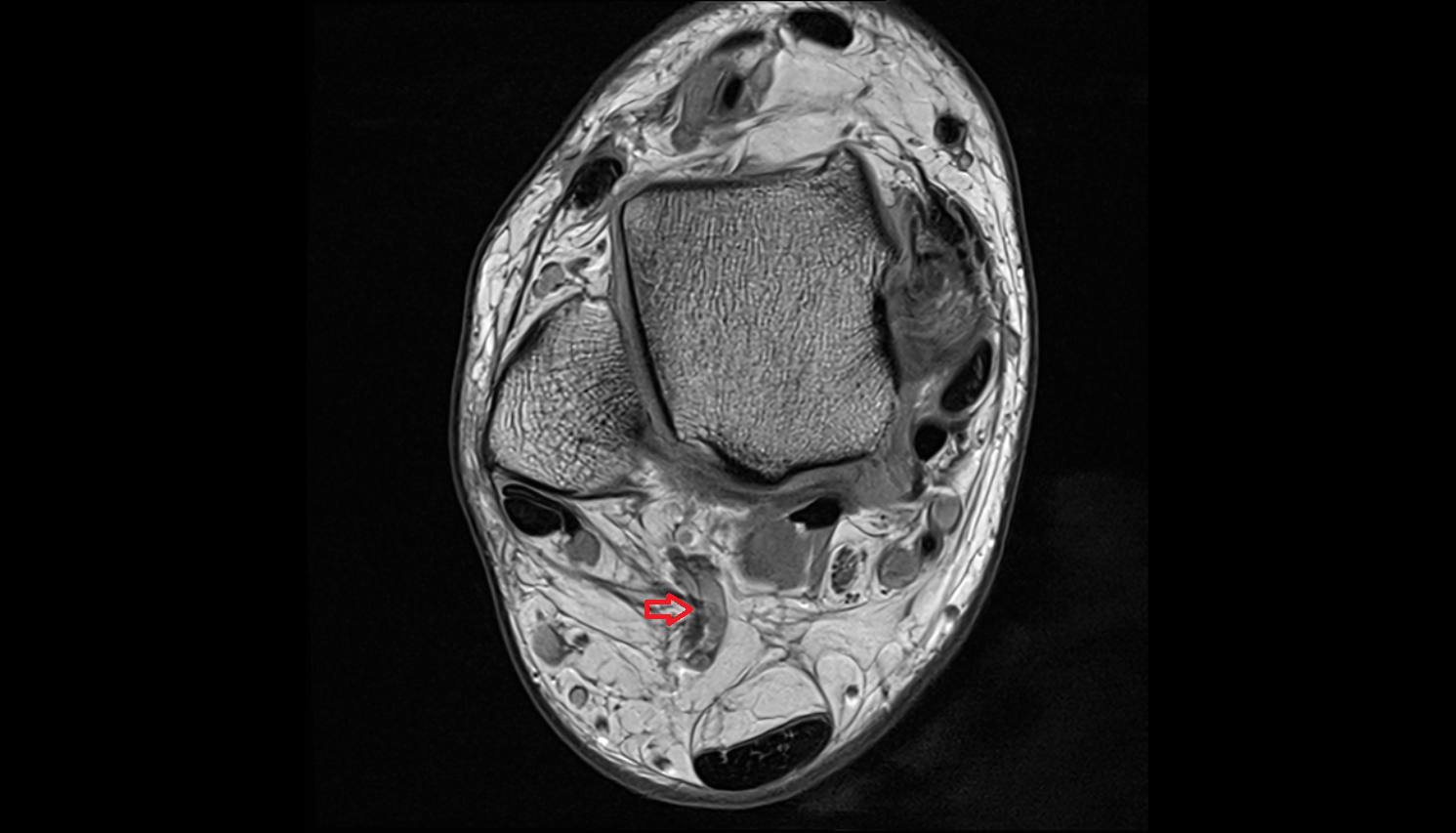 Lateral calcaneal artery axial  cross sectional anatomy 3T MRI AI enhanced radiology image-img-00000-00000