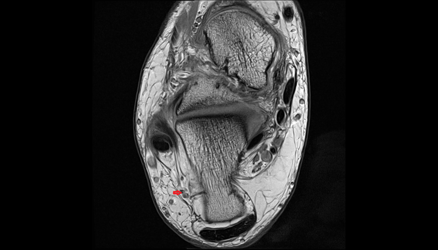 Lateral calcaneal artery axial  cross sectional anatomy 3T MRI AI enhanced radiology image-img-00000-00000_00001