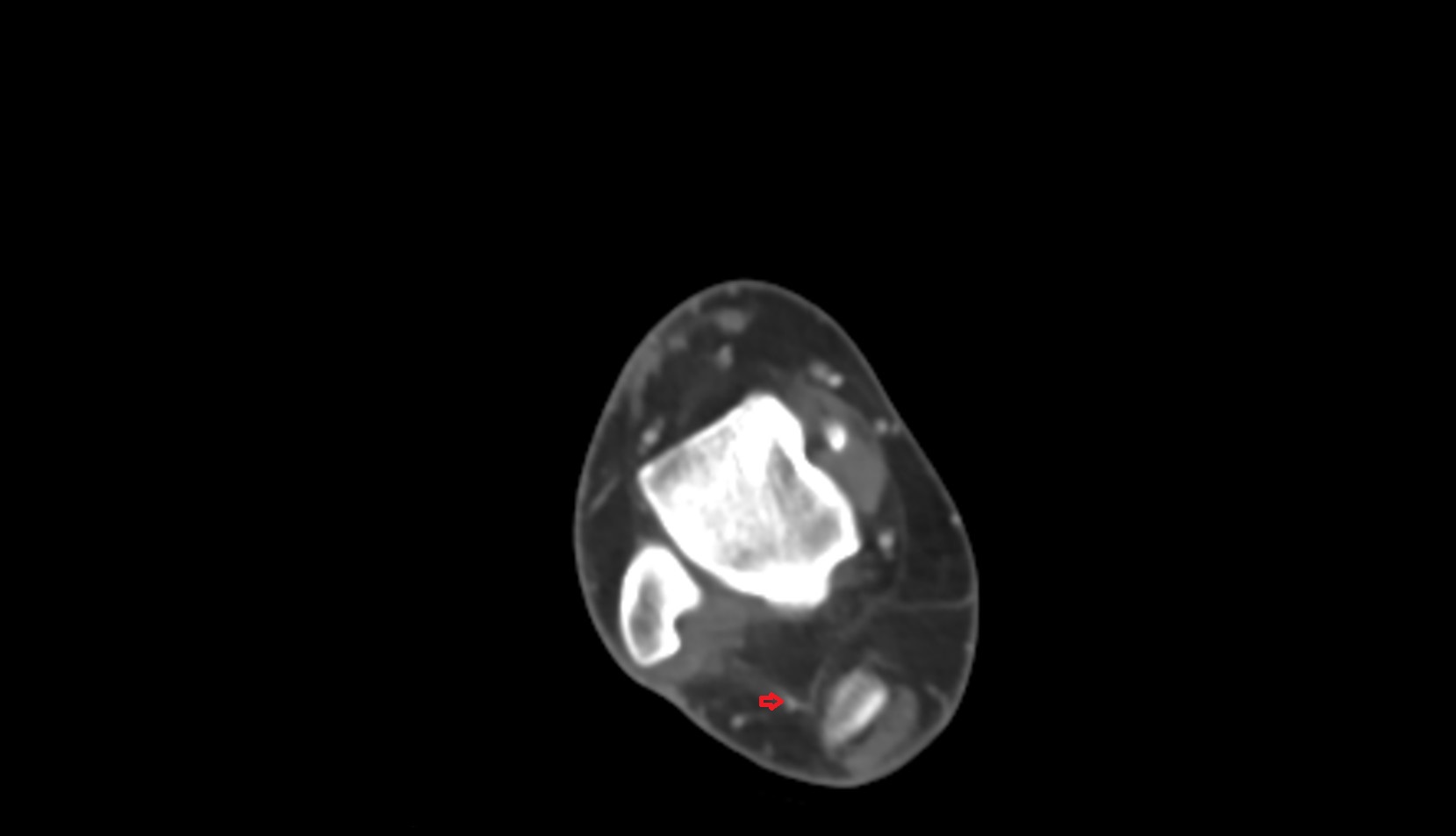 Lateral calcaneal artery ct axial 1