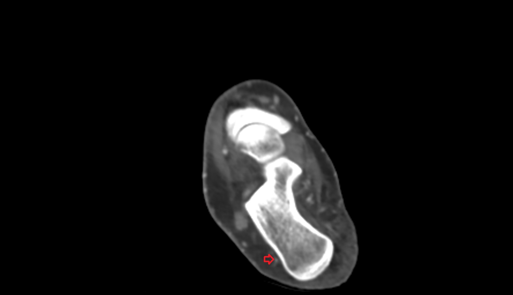 Lateral calcaneal artery ct axial 2