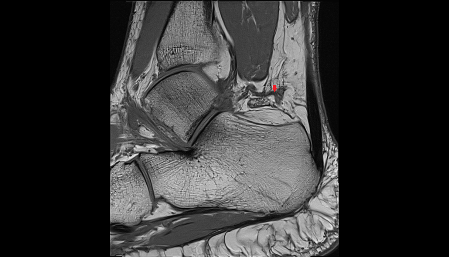 Lateral calcaneal artery sag  cross sectional anatomy 3T MRI AI enhanced radiology image-img-00000-00000
