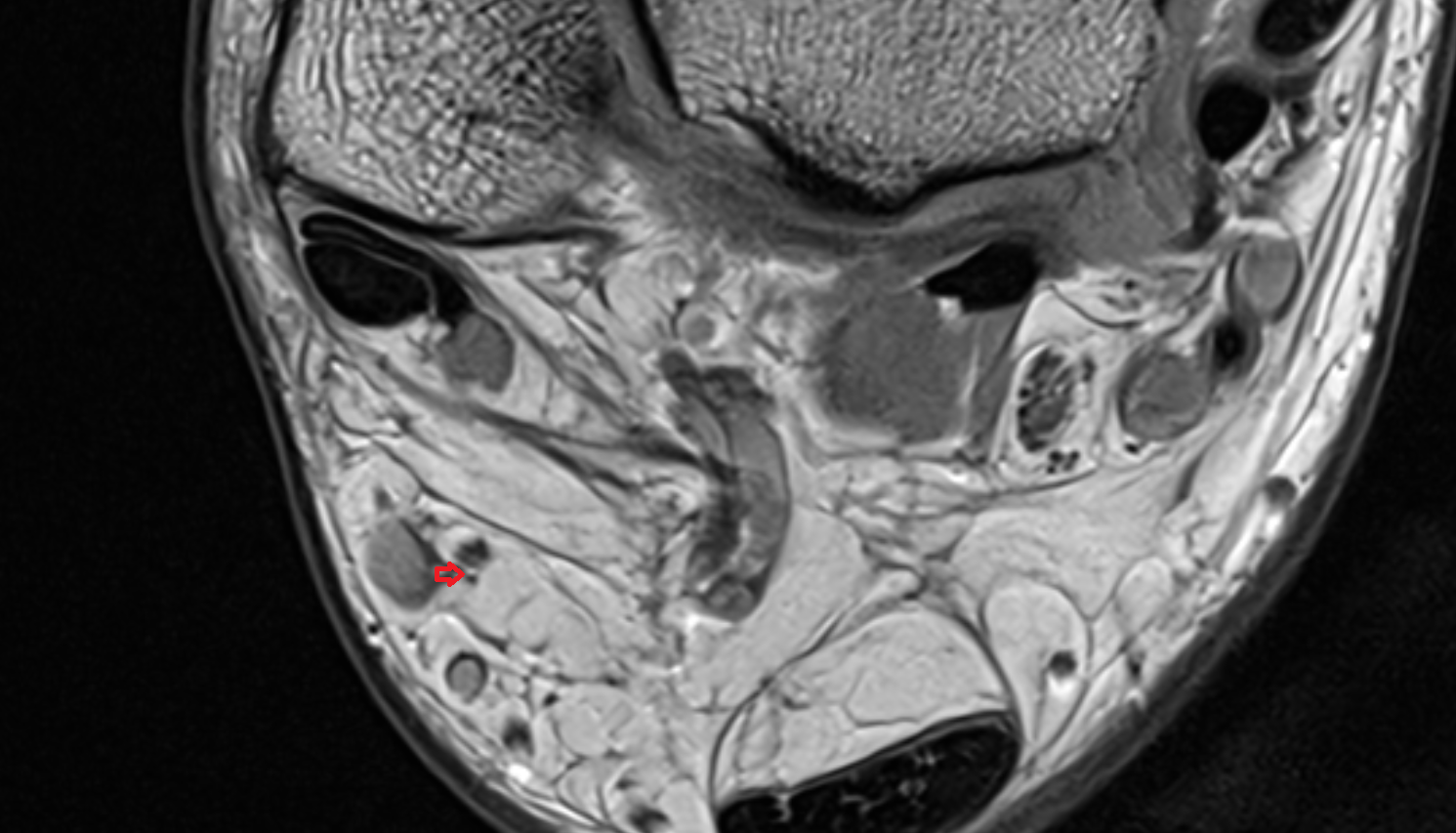 Lateral calcaneal branches of sural nerve axial  cross sectional anatomy 3T MRI AI enhanced radiology image-img-00000-00000