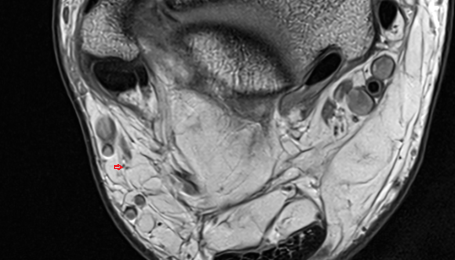 Lateral calcaneal branches of sural nerve axial  cross sectional anatomy 3T MRI AI enhanced radiology image-img-00000-00000_00001