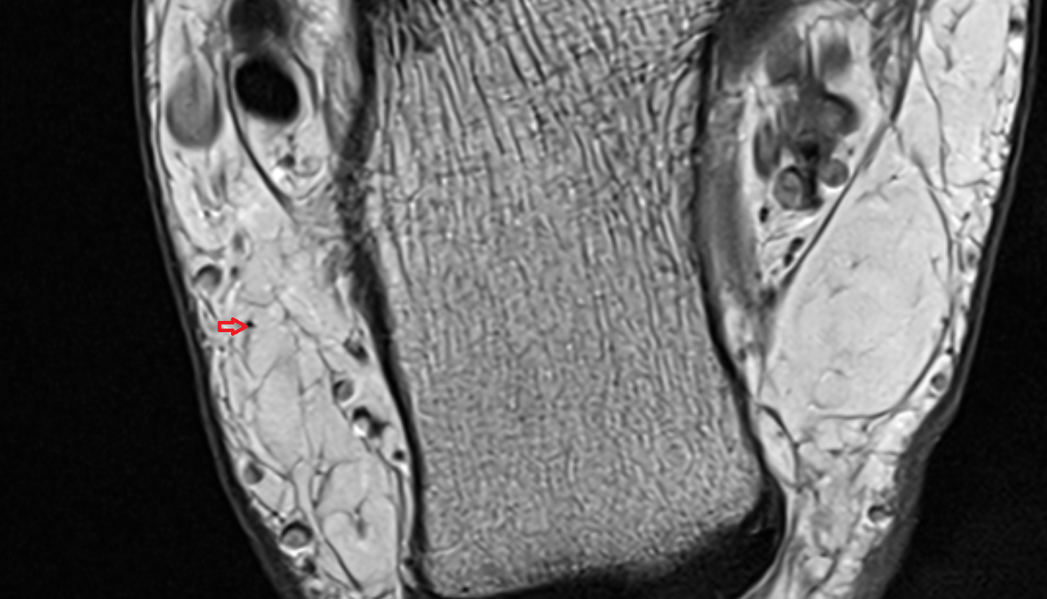 Lateral calcaneal branches of sural nerve axial  cross sectional anatomy 3T MRI AI enhanced radiology image-img-00000-00000_00002