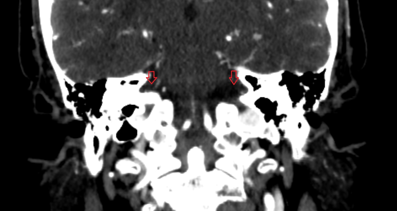 Lateral cerebellomedullary cistern CT coronal anatomy image -img-00001-00001
