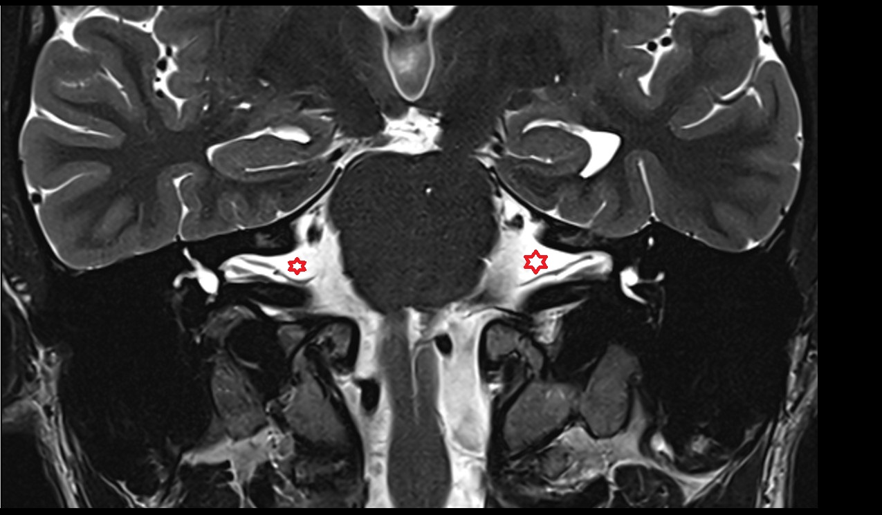 Lateral cerebellomedullary cistern mri 3t coronal  image