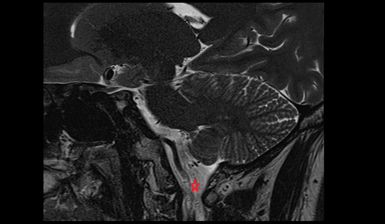 Lateral cerebellomedullary cistern mri 3t sagittal image