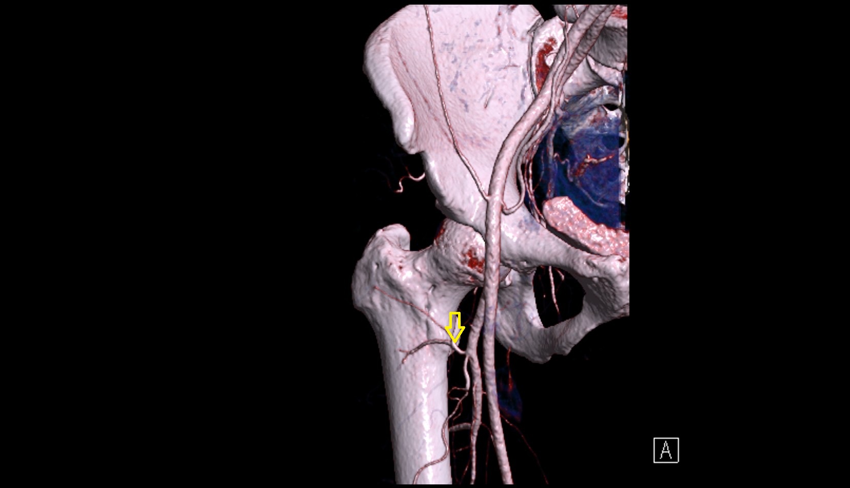 Lateral circumflex femoral artery CT 3D VRT anatomy image