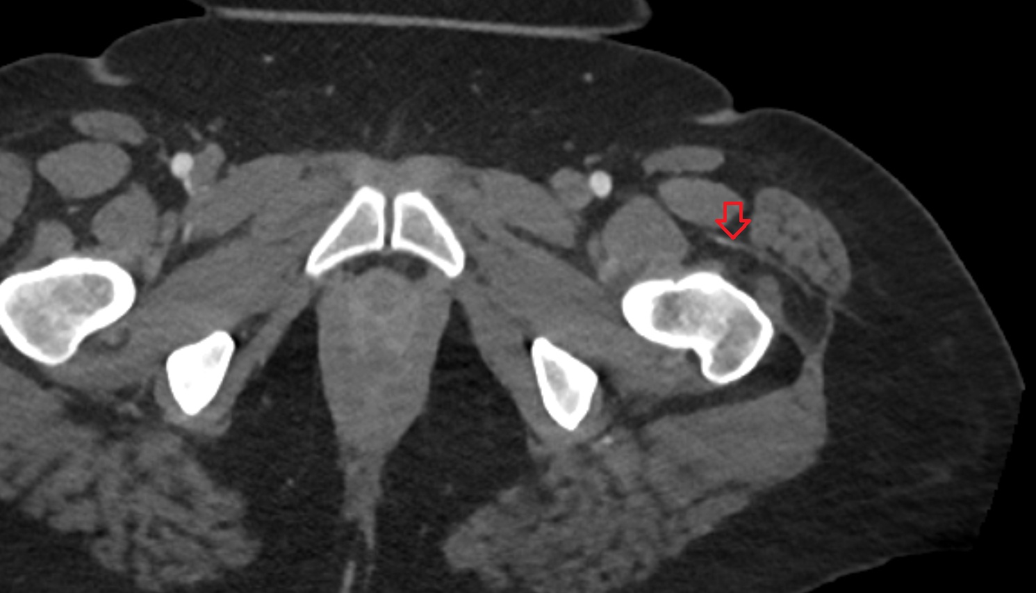Lateral circumflex femoral artery CT axial image  MRI  axial  anatomy  image-img-00000-00000