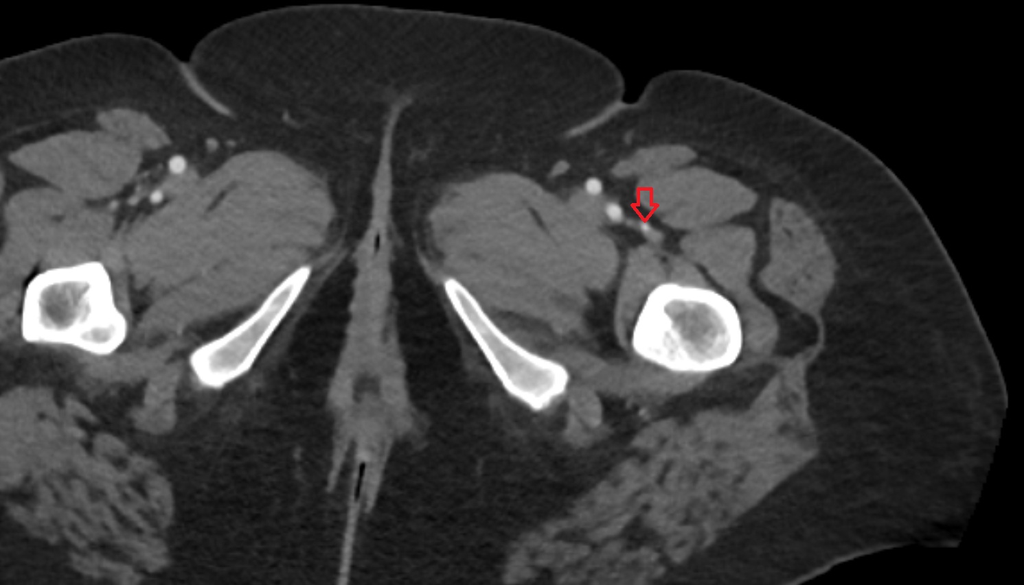 Lateral circumflex femoral artery CT axial image  MRI  axial  anatomy  image-img-00000-00000_00001