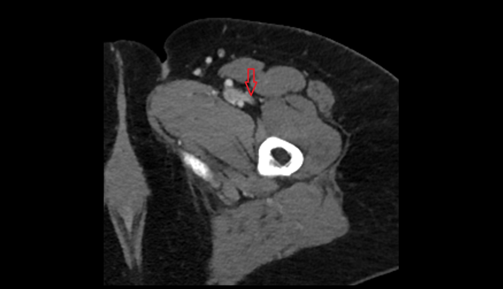 Lateral circumflex femoral veins axial ct image 0