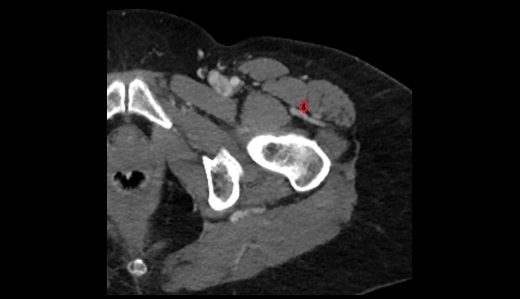 Lateral circumflex femoral veins axial ct image 1