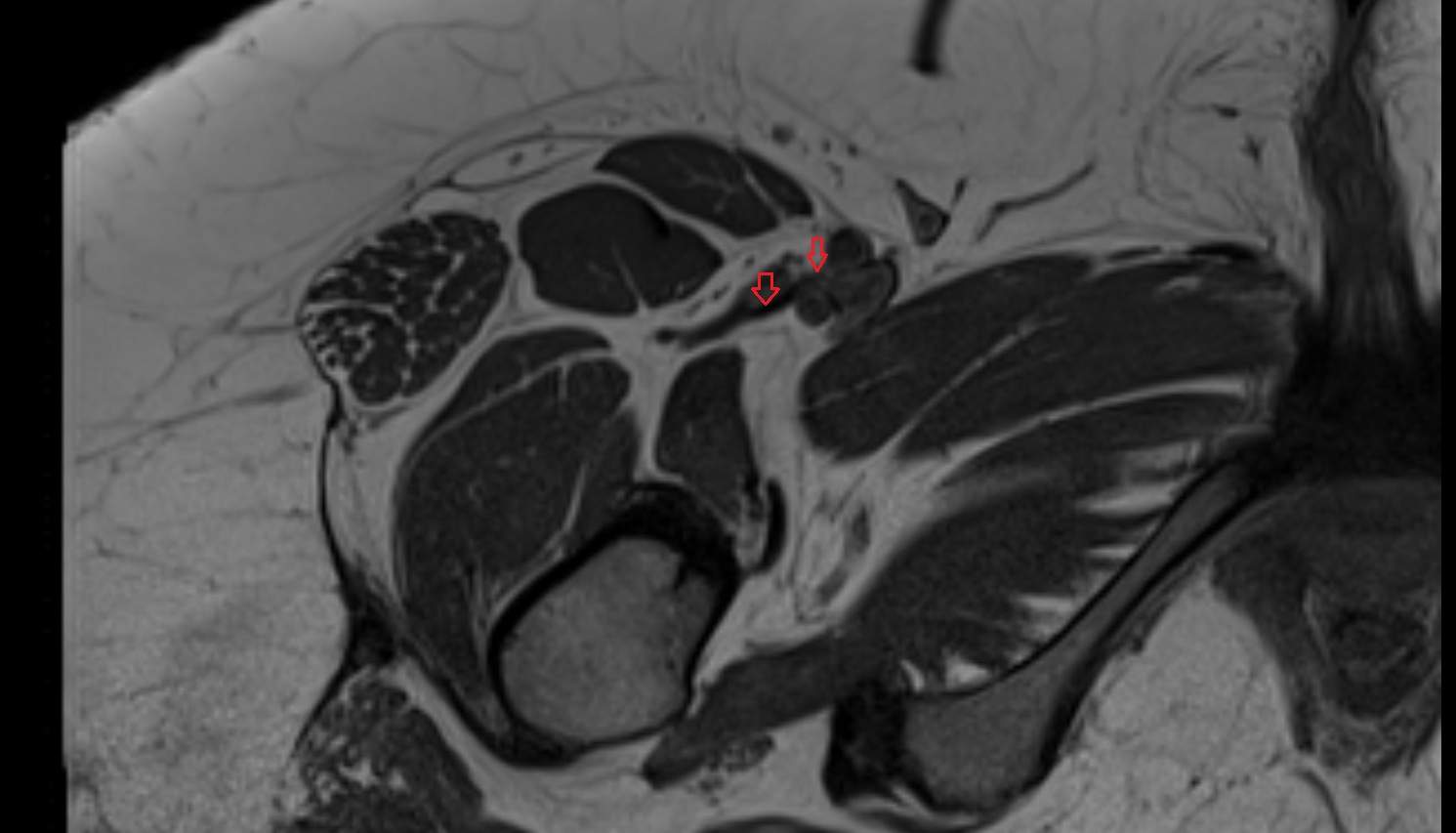 Lateral circumflex femoral veins axial ct image  MRI  axial  anatomy  image-img-00000-00000