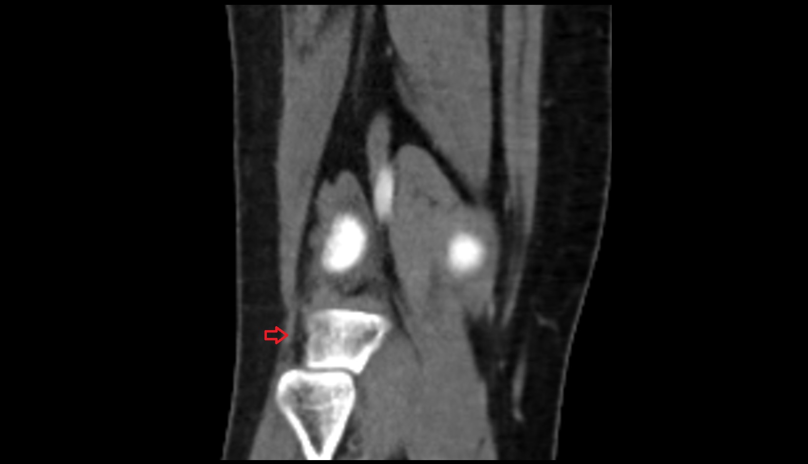Lateral collateral ligament (LCL) 1