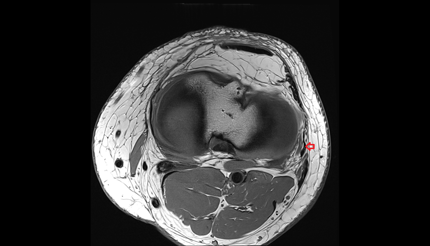 Lateral collateral ligament (LCL)  axial cross sectional anatomy 3T MRI AI enhanced  radiology  anatomy image-img-00000-00000