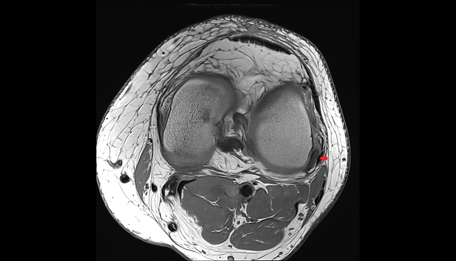 Lateral collateral ligament (LCL)  axial cross sectional anatomy 3T MRI AI enhanced  radiology  anatomy image-img-00000-00000_00001