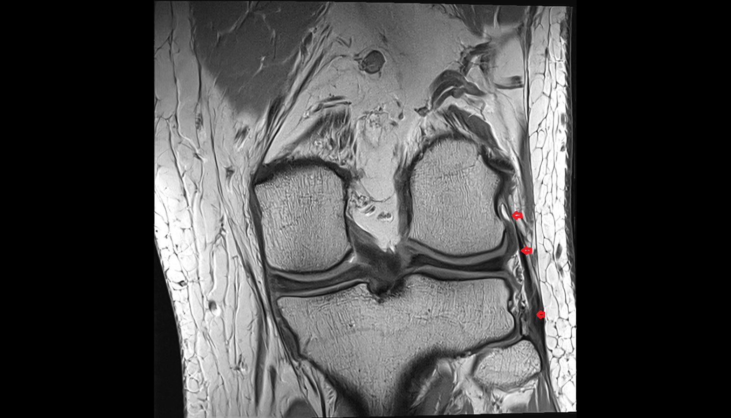 Lateral collateral ligament (LCL)  coronal cross sectional anatomy 3T MRI AI enhanced  radiology  anatomy image-img-00000-00000