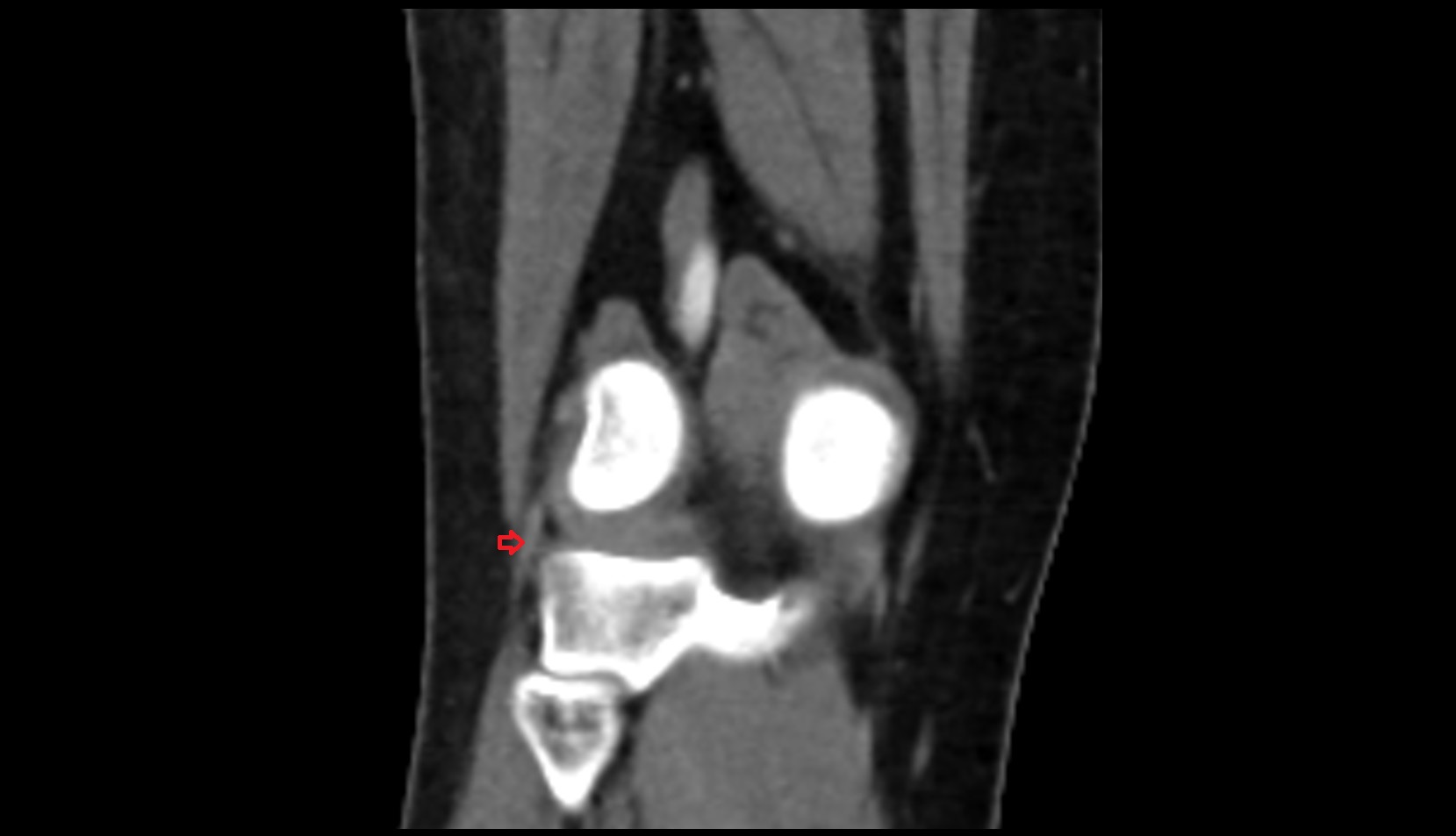 Lateral collateral ligament (LCL) ct coronal image