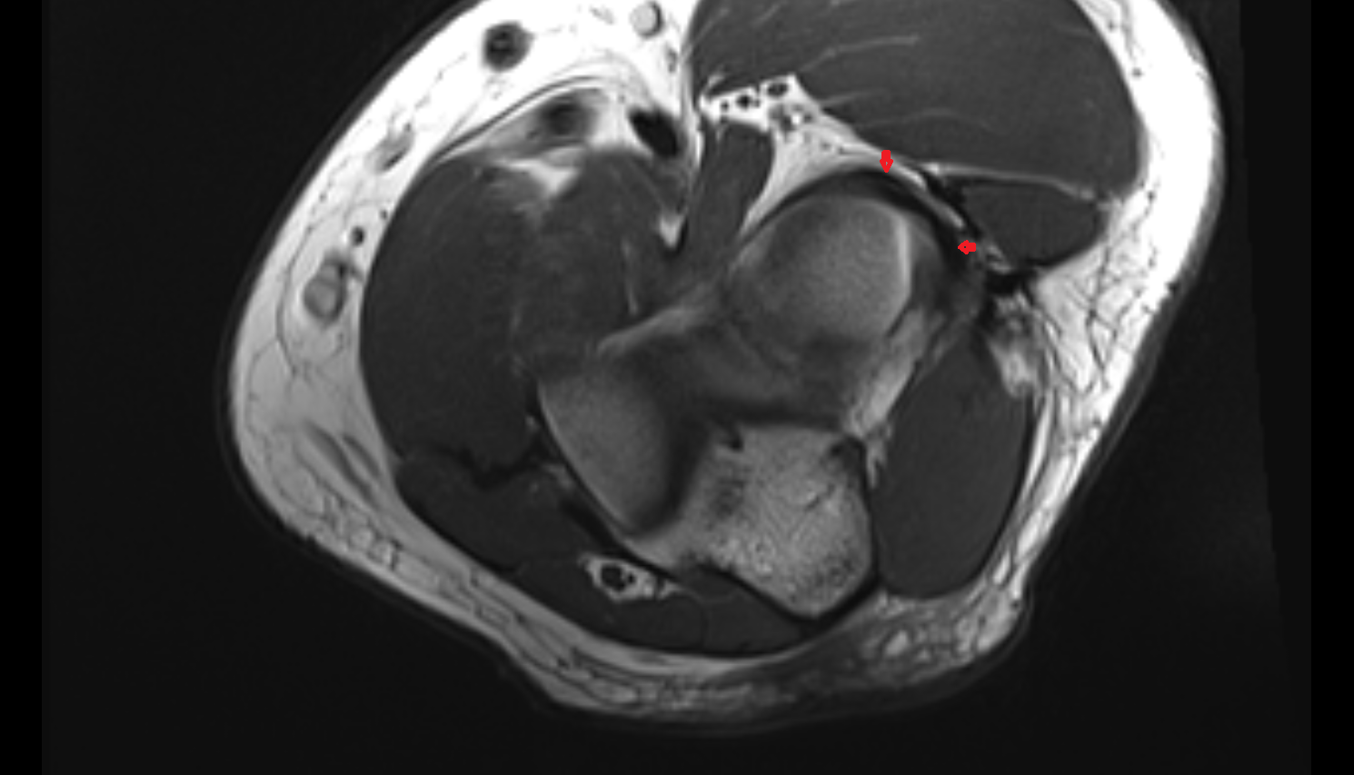 Lateral collateral ligament complex elbow, axial cross sectional anatomy 3T MRI AI enhanced radiology image -img-00000-00000