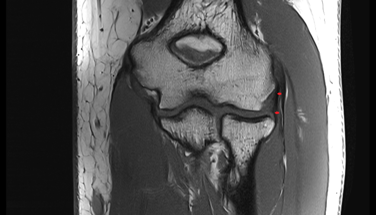 Lateral collateral ligament complex elbow coronal cross sectional anatomy 3T MRI AI enhanced radiology image -img-00000-00000