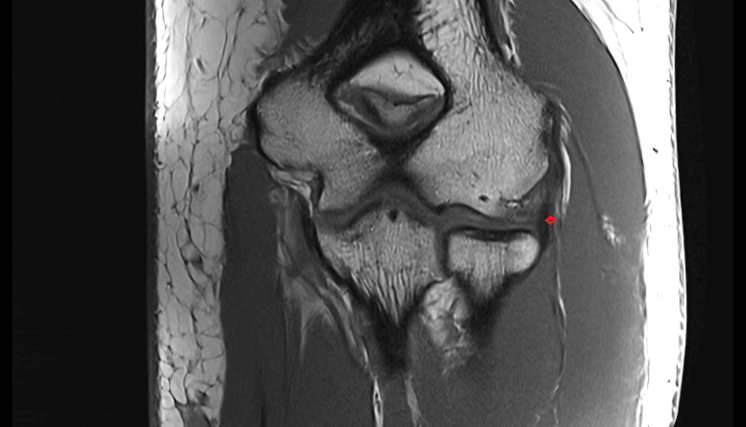 Lateral collateral ligament complex elbow coronal cross sectional anatomy 3T MRI AI enhanced radiology image -img-00000-00000_00001