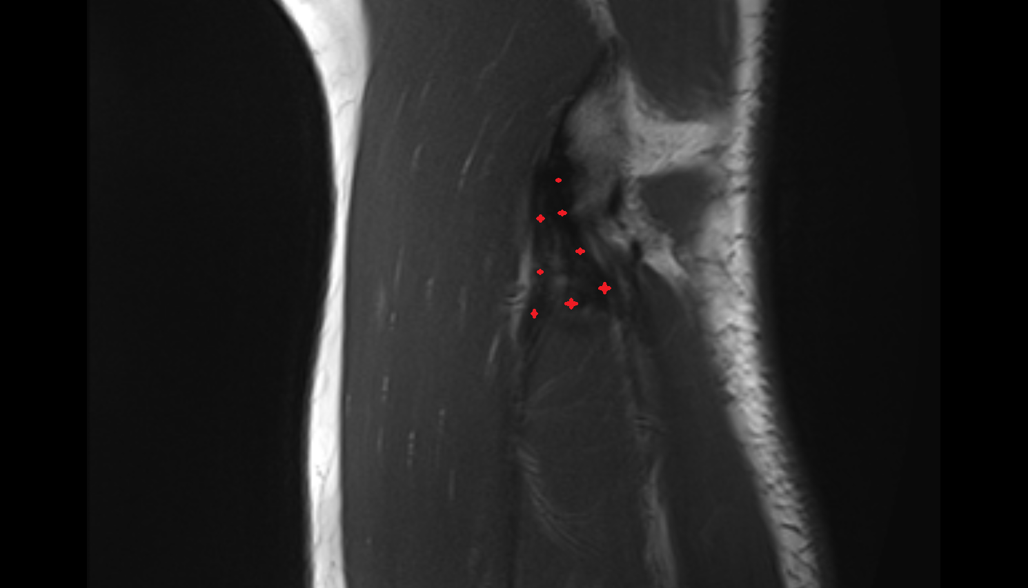 Lateral collateral ligament complex elbow, sag cross sectional anatomy 3T MRI AI enhanced radiology image -img-00000-00000_00002