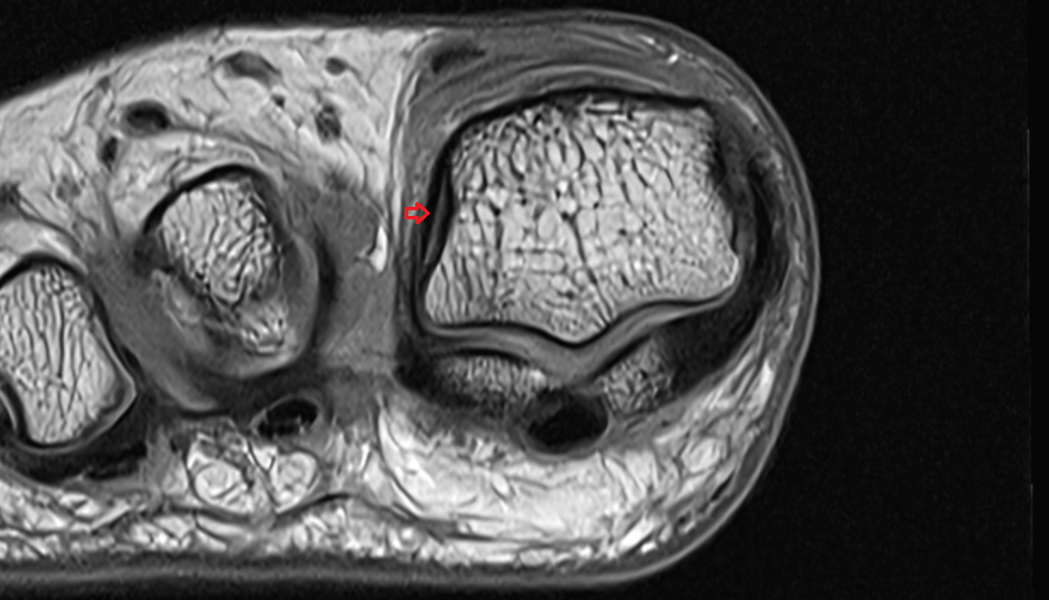 Lateral collateral ligament of big toe (lateral metatarsophalangeal collateral ligament)  axial cross sectional anatomy 3T MRI AI enhanced radiology image-img-00000-00000
