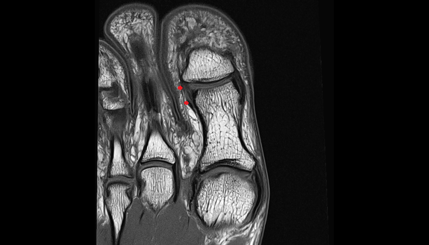 Lateral collateral ligament of interphalangeal joint of foot  coronal cross sectional anatomy 3T MRI AI enhanced radiology image-img-00000-00000