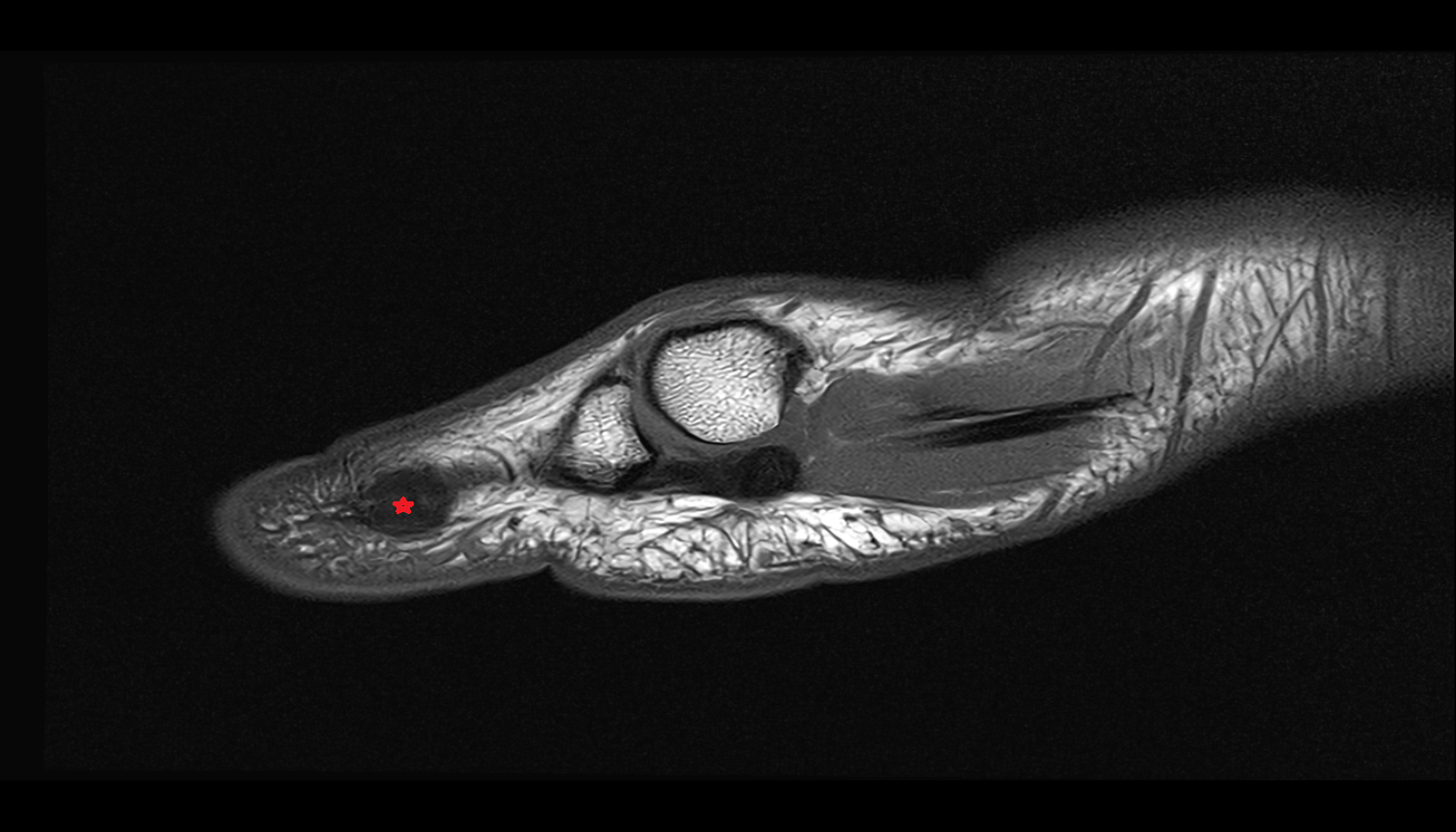 Lateral collateral ligament of interphalangeal joint of foot  sag cross sectional anatomy 3T MRI AI enhanced radiology image-img-00000-00000_00002