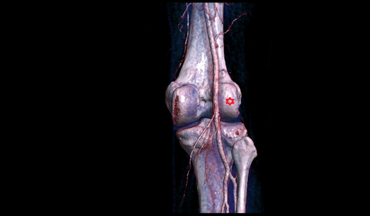 Lateral condyle of femur 3d image