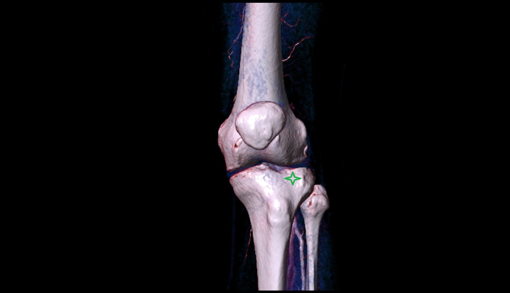 Lateral condyle of tibia