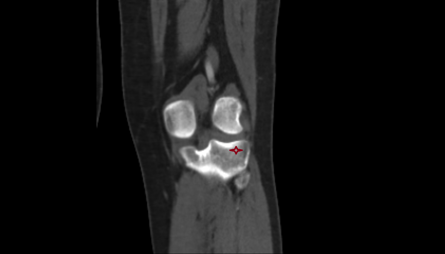 Lateral condyle of tibia ct anatomy labelled image-img-00000-00000