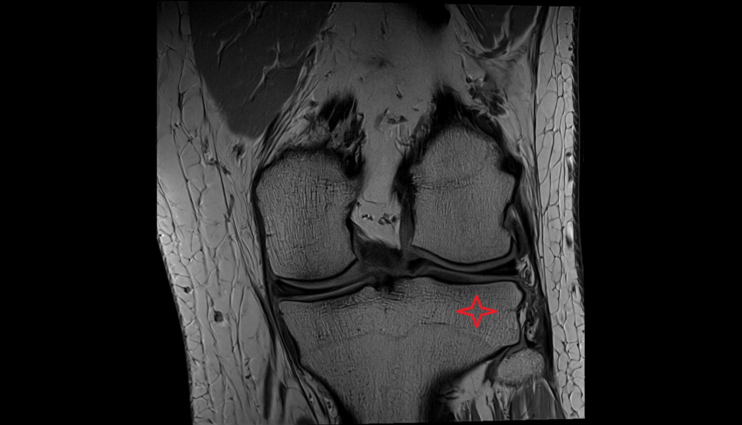 Lateral condyle of tibia  mri anatomy labelled image-img-00000-00000