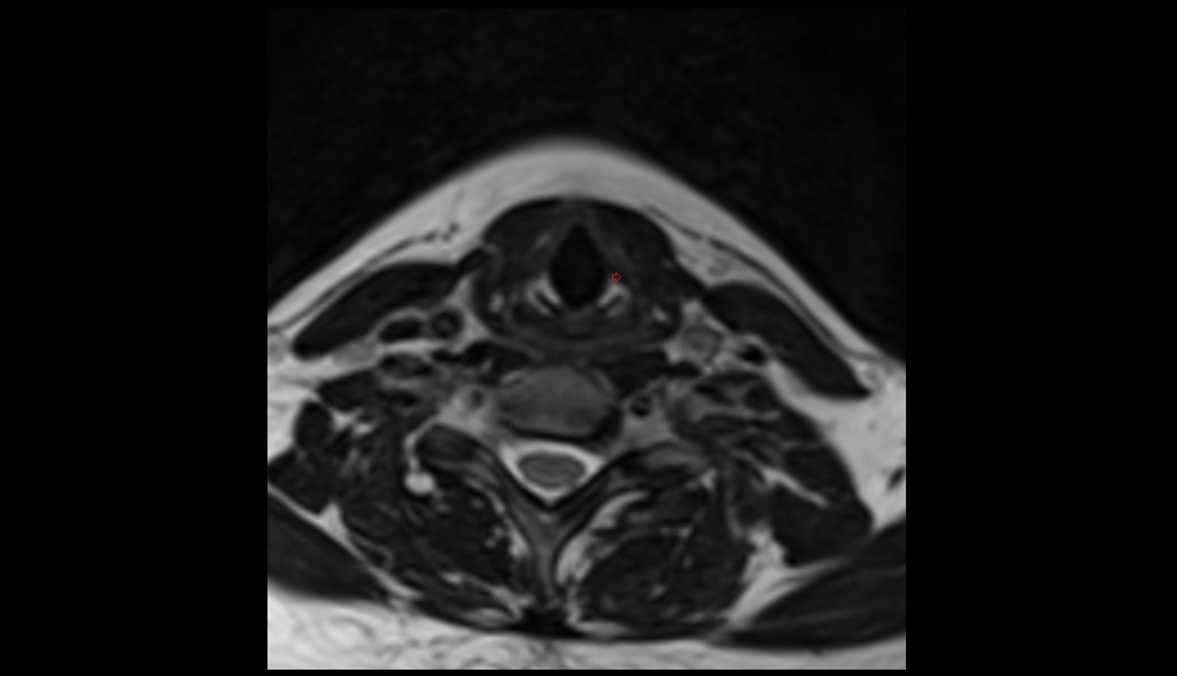 Lateral cricoarytenoid muscle mri axial image