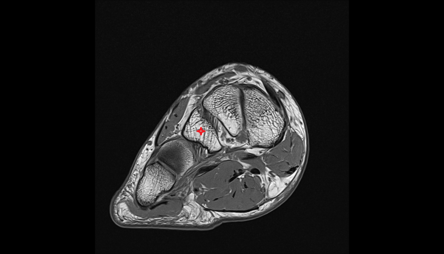 Lateral cuneiform bone   MRI coronal  cross sectional anatomy 3T MRI AI enhanced radiology image-img-00000-00000