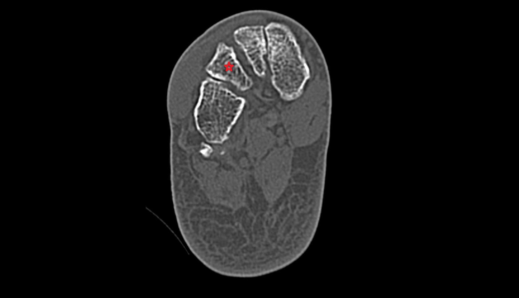 Lateral cuneiform bone ct axial