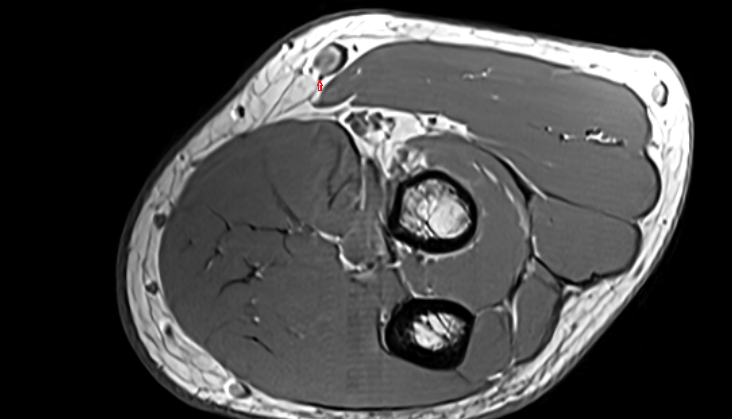 Lateral cutaneous nerve of forearm  axial cross sectional anatomy 3T MRI AI enhanced radiology image -img-00000-00000_00001