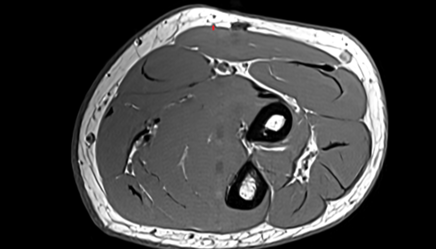 Lateral cutaneous nerve of forearm  axial cross sectional anatomy 3T MRI AI enhanced radiology image -img-00000-00000_00002