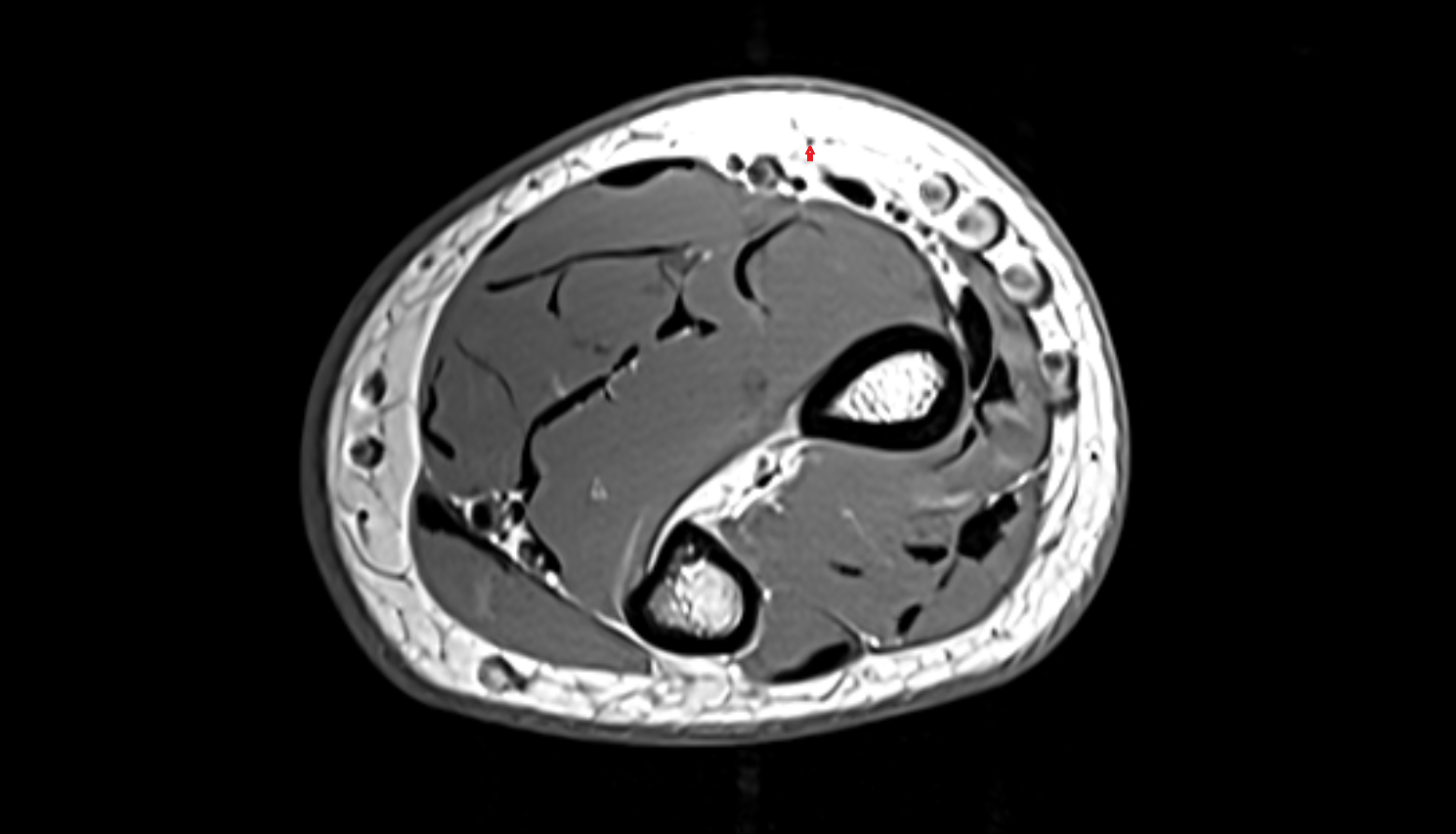 Lateral cutaneous nerve of forearm  axial cross sectional anatomy 3T MRI AI enhanced radiology image -img-00000-00000_00004