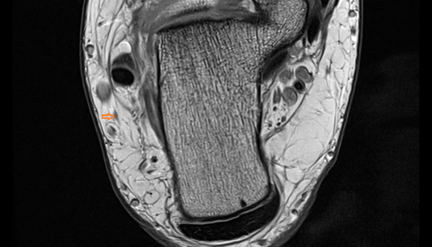 Lateral dorsal cutaneous nerve  axial cross sectional anatomy 3T MRI AI enhanced radiology image-img-00000-00000